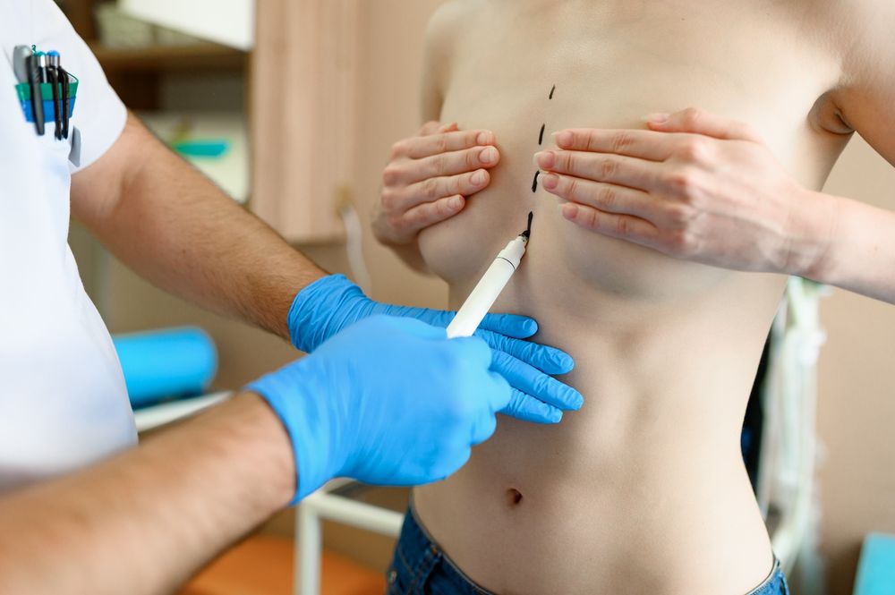 Un médecin dessine une ligne pointillée entre les seins d'une poitrine féminine.