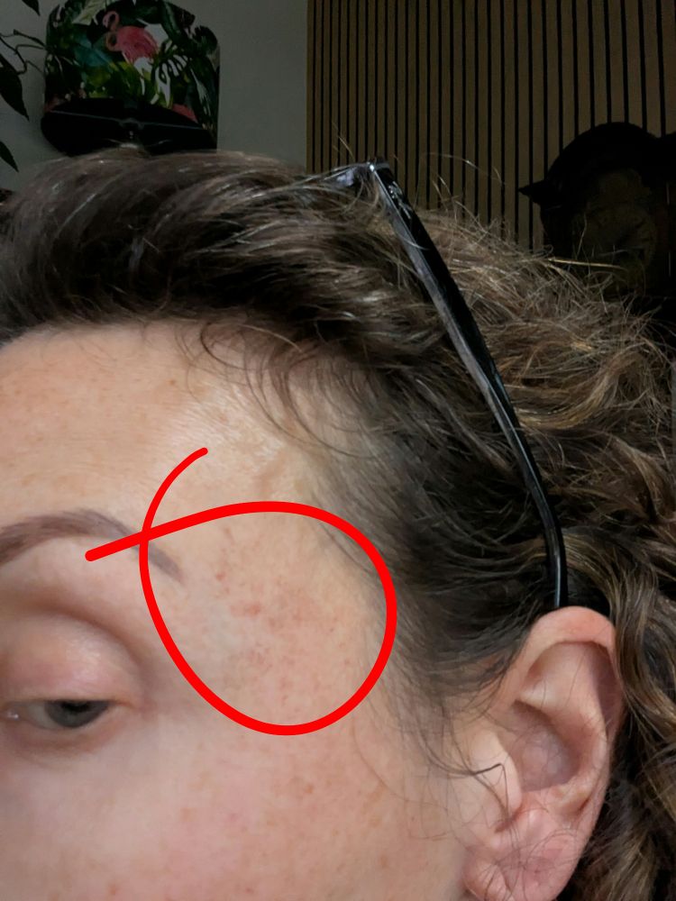 Side view of a white skinned face. A red circle highlights a section where the top layer of skin has been abraded off, leaving light scabbing. Nice, Huh? 