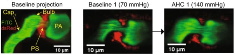 Showing how a precapillary sphincter dilates during high blood pressure