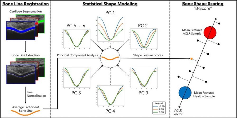 Development of SSM and B-Score Process. Overview of the process to develop the statistical shape model (SSM) and B-score. Bone Line Registration: Three ultrasound images from one knee are acquired and their cartilage segmented; the bone line is then extracted from the cartilage and normalized. Statistical Shape Modeling: PCA is performed to obtain shape feature scores for each bone line. Bone Shape Scoring: Bone line shape feature scores are projected onto the ACLR vector, resulting in the B-Score. 