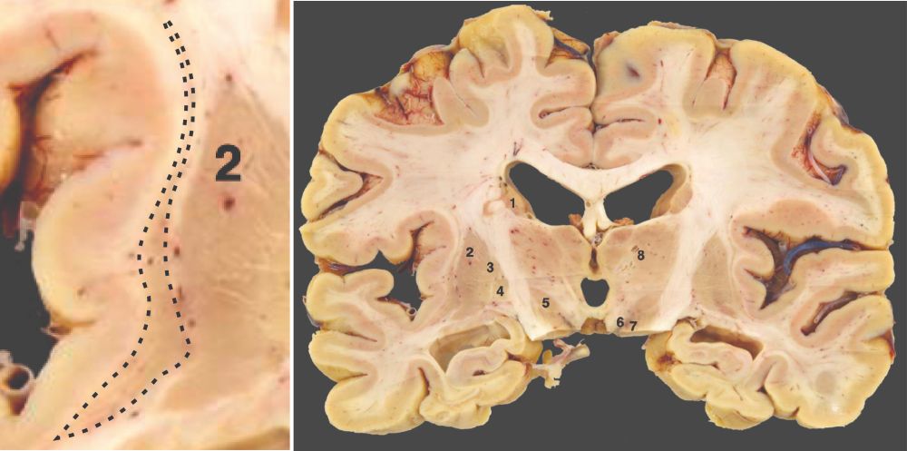 Every year during neuroanatomy practical classes, medical students ask the same questions: "What is this structure located between the insula and the putamen? Is it part of the basal ganglia involved in motor control?