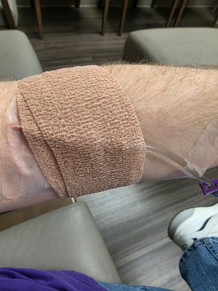 IV in arm