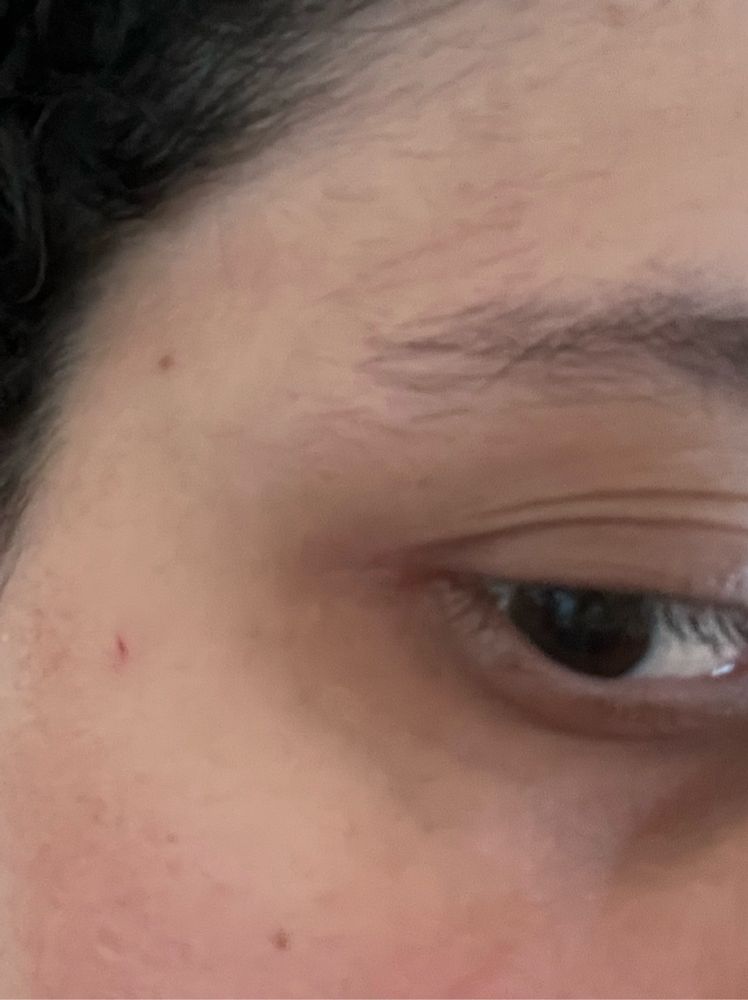 Foto de um cortezinho perto do olho feito por um gato fdp