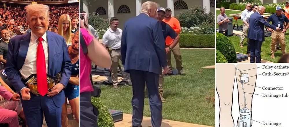 photo of the back of trump showing the outline of what appears to be a catheter.