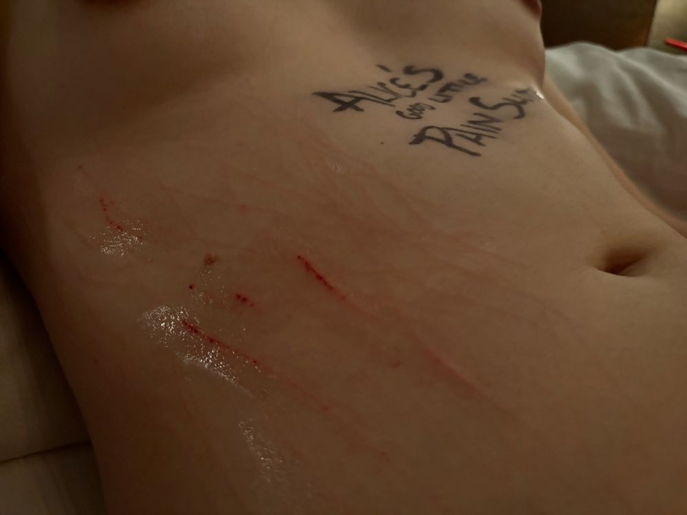 A shot of my torso after my first time experiencing the “the claws.” My breasts are visible in the top of the frame. “Alice’s Good Little Pain Slut” is written on my chest. My right flank is scratched up and red with hundreds of claw marks. A select few claw marks are deeper and blood has been drawn. My wounds are shiny as they have been treated with antiseptic, anti-scar gel, and witch hazel.