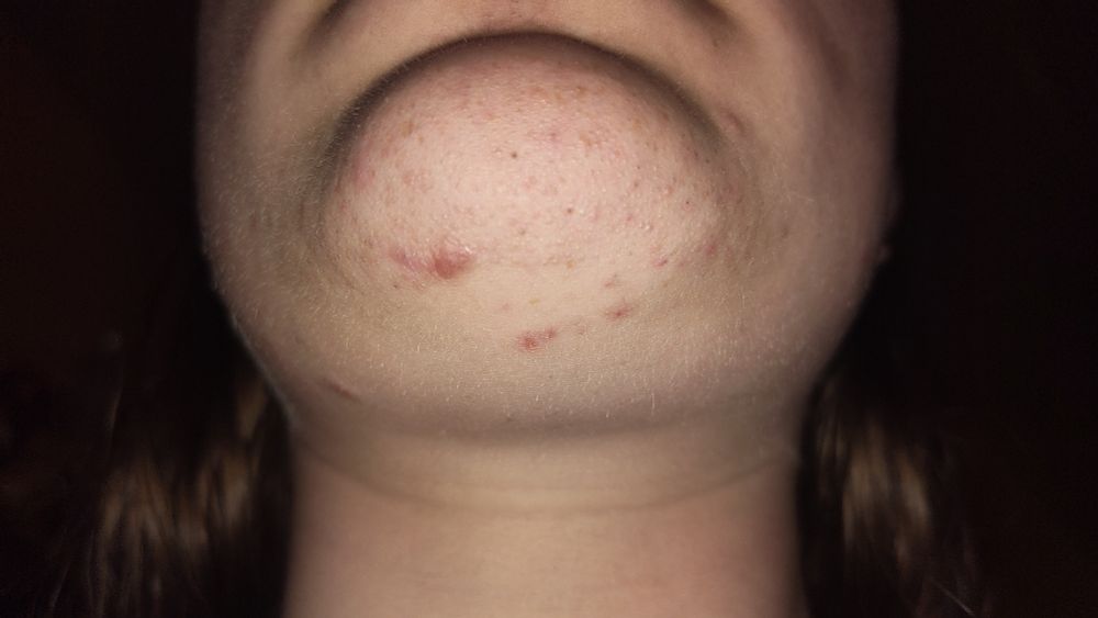 Photo of underneath chin. On the right side of the chin (left in the photo) is a scar from a gash. Scar is noticeably irritated because OP has issues with getting obsessive about plucking.