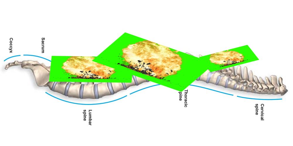 A labeled diagram of the human spine covered in green screen explosions
