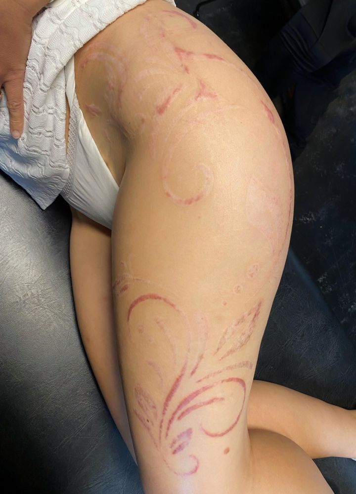 the same pattern, but healed to be covered by skin again, some of it reddish, other parts light pink or slightly whitish