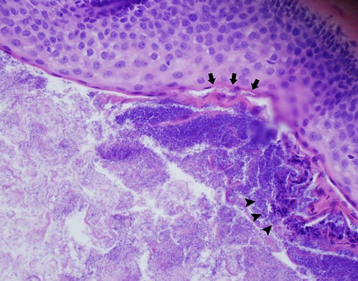 Purple pathology image showing that the cyst was limited by an outer stratified squamous epithelium with an undulating eosinophilic cuticle. Image also shows that intralesional contents included keratin and notably multiple basophilic spheric inclusions.