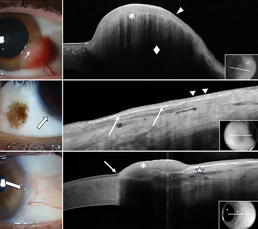 Three colour images showing eyes with different ocular surface lesions appear in a column on the left side of the image. Next to each is a corresponding black and white high-resolution optical coherence tomography image show the location of each lesion.