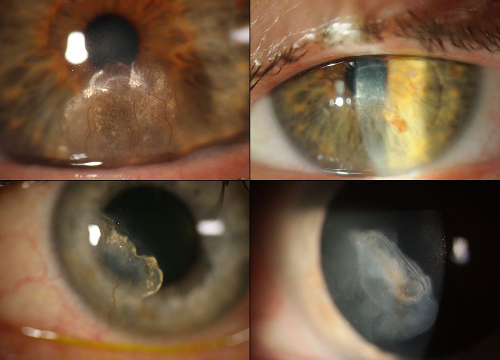 Collage of 4 images showing 2 eyes with interstitial keratitis. The left panels show eyes with scarring over the cornea and the right panels show the same eyes after long-term treatment with tacrolimus. The scarring in both eyes is significantly reduced.
