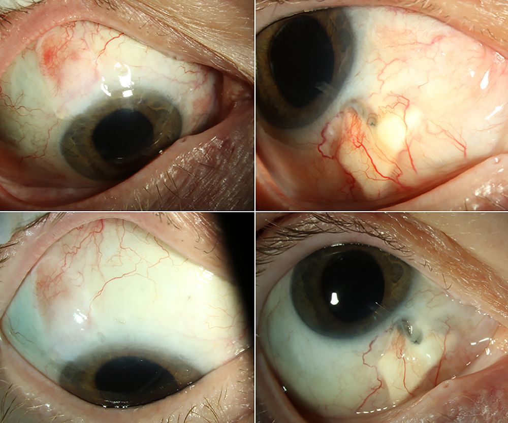 Slit lamp images showing chronic recurrent conjunctival erosions secondary to cabozantinib.