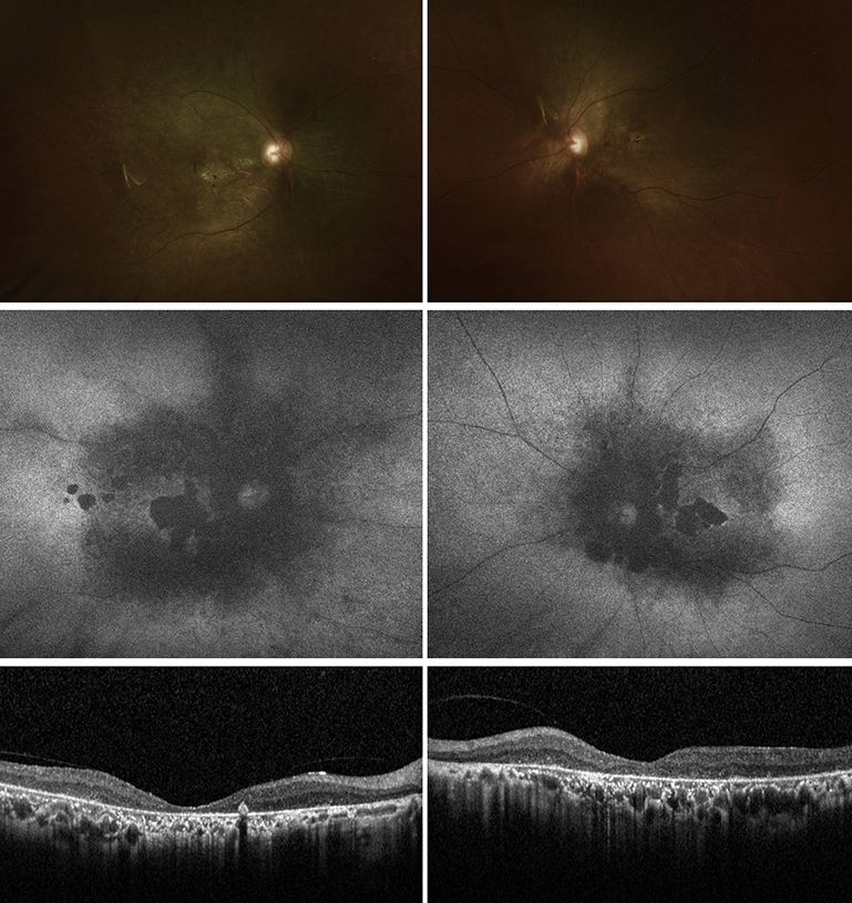Multimodal imaging from female patient. Top images show wide-field colour fundus photos. Middle images show black and white fundus autofluorescence images. Bottom images show black and white spectral-domain optical coherent tomography.