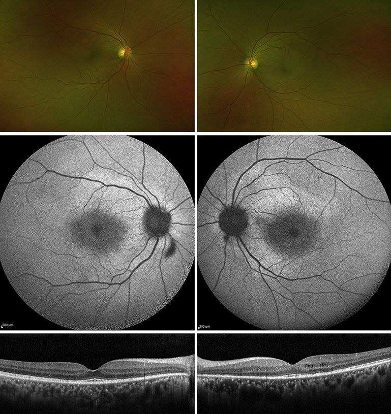 Multimodal imaging from male patient. Top images show wide-field colour fundus photos. Middle images show black and white fundus autofluorescence images. Bottom images show black and white spectral-domain optical coherent tomography.