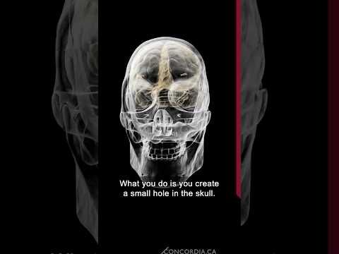 iSurgARy, a new technique for ventriculostomy