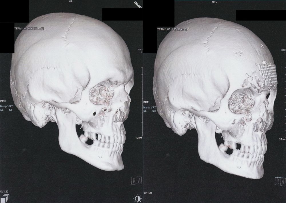 Two 3D CT scans of a skull. The right one has larger eye sockets, less nose and chin material and a metal mesh on the forehead 