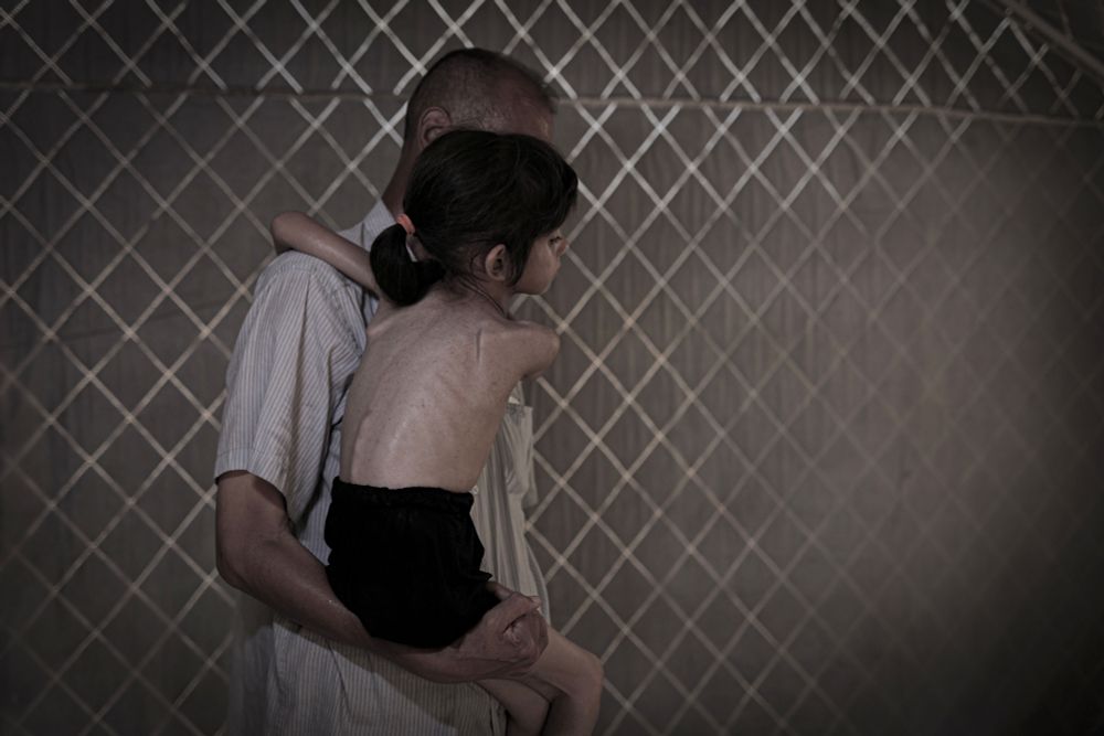 A man holds a severely undernourished child in his arms. (Mohammed Y. M. Al-yaqoubi / Anadolu / Getty)