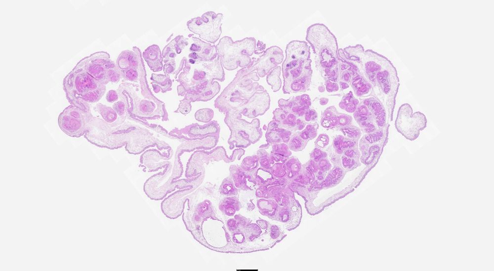 Subgross section of the biopsy sample from this cat.   Multiple scolices are attached to the inside of the cyst visible on MRI.  This is consistent with a coenurus. Taenia sp., including Taenia multiceps, Taenia serialis, Taenia brauni, and Taenia glomeratus are capable of producing coenuri.  A hydatid cyst could have a similar appearance but a coenurus is more likely given the signalment and location of the patient. PCR and sequence results are pending.
