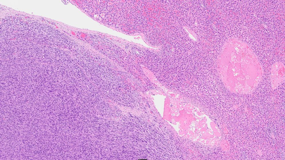This image demonstrates the fibrosarcoma on the right and the interface with the extant hepatic parenchyma on the left.  The neoplasm is well demarcated in this section. In others it was more directly invasive and widespread metastases were all through the abdomen.  This seemed to be a case of true sarcomatosis.  Implantation of bits of neoplasia directly on the serosal surfaces of the abdomen, leading to additional tumors.