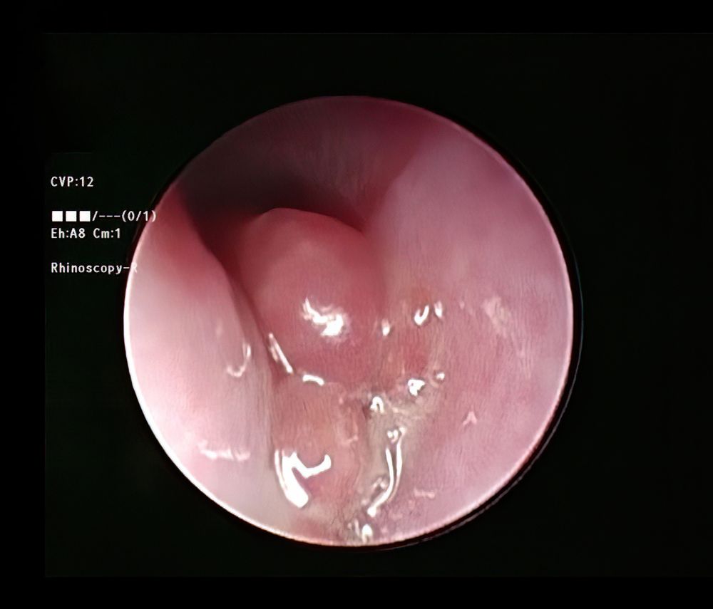 Multiple nodules (slightly polypoid) protruding from nasal mucosa of a dog.  The nodules are only slightly darker pink than the more normal mucosa.