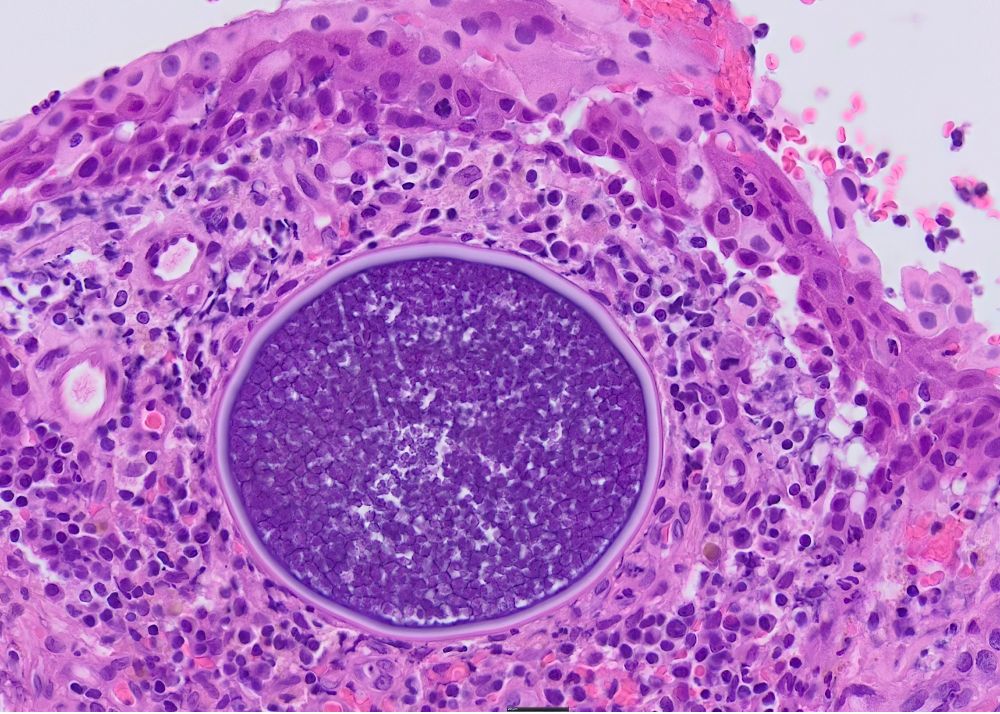 Large, perhaps 200-micrometer-diameter, spherical organisns with a trilaminar wall and multiple smaller structures inside.  It lies in the submucosa of the nose and is surrounded by macrophages, lymphocytes and plasma cells.