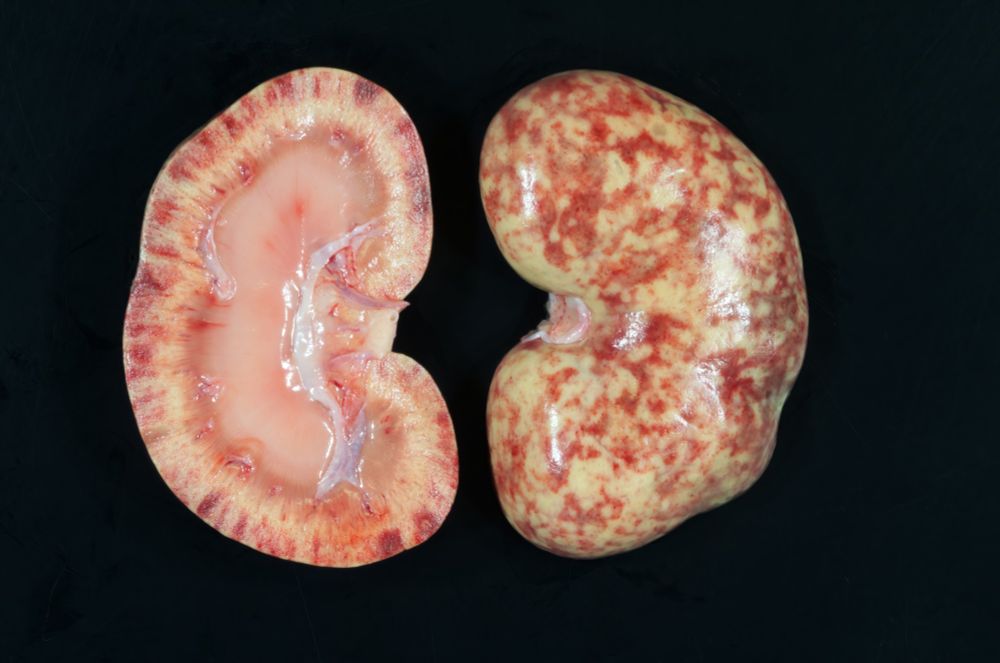The image depicts the right kidney from this case that has been sectioned longitudinally through the hilum.  The section on the left shows the cut surfaces.  The one on the right shows the capsular surface with the capsule removed.  The capsular surface is speckled red and yellow with hundreds of widely scattered, pinpoint, red foci that are only visible with very close inspection (suspect congested or hemorrhagic glomeruli). The larger red foci account for half of the surface of the right kidney and they extend into the outer one-half of the cortex on cut surfaces. The kidney is otherwise pale.
