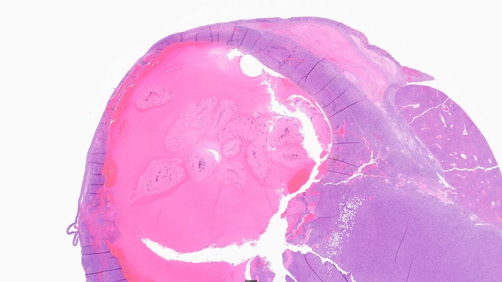 This is a subgross image of liver with a large tumor containing a blood filled cavity that has multiple sections of tapeworm larvae. A bit of the hepatic parenchyma is on the upper right.  H&E-stained section.  