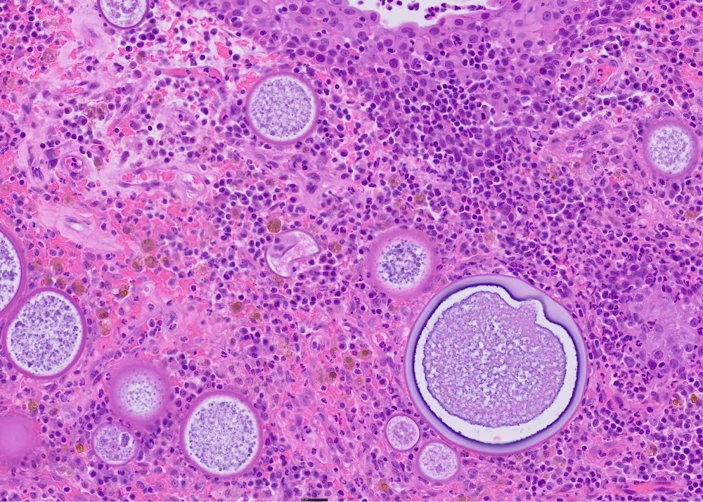 Spherical organisms of variable diameter but typically very large, with a thick capsule and grainy contents.  These structures have thick walls, but only the largest has a trilaminar wall. The organisms are in the submucosa of the nose and are surrounded by macrophages, lymphocytes and plasma cells. Some macrophages contain hemosiderin.