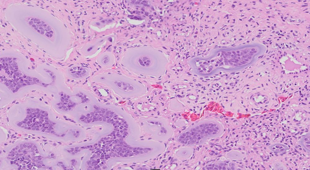 Another high magnification view of the ovarian neoplasm from a giant garter snake. The tumor is composed of cords and islands of epithelial cells surrounded by a wide margin of amphophilic material interpreted to be basement membrane material.