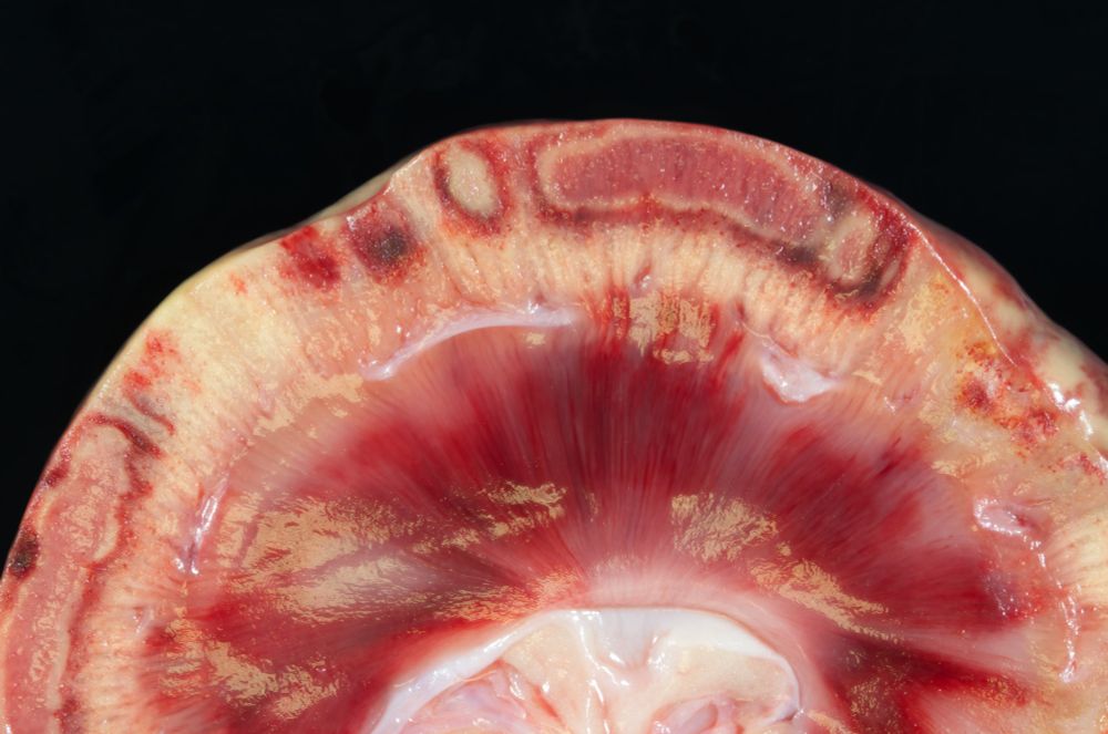 A macroscopic image of the canine kidney previously described. Less affected regions are uncharacteristically yellow. There are scattered aminar, supericial-cortical lesions. The smallest are dark red.  The largest have a pink core with a ground glass surface (necrosis) surrounded by a 1-mm-thick yellow margin that is in turn surrounded by a 1-mm-thick, red outer margin of tissue.  If you look closely you can see pin-point red structures scattered throughout the cortex that correspond to glomeruli.
