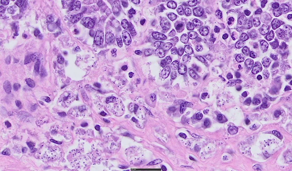 Small intestine from a dog with a predominately histiocytic infiltrate.  Macrophages contain numerous, very small organisms.
