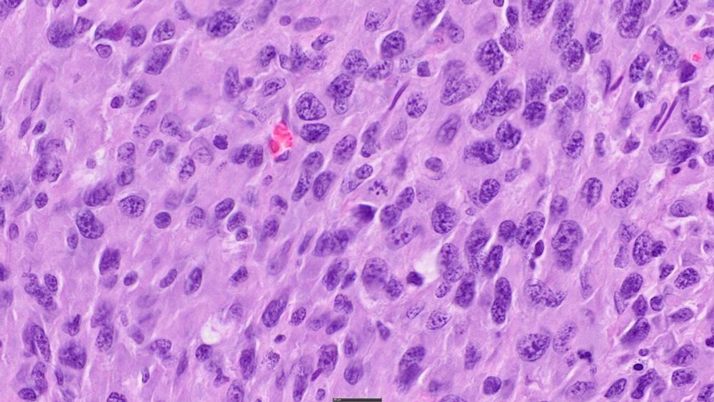 A high magnification image of this neoplasm.  Neoplastic cells have significant variability in size.  They are generally oval to round.  Mitotic figures and apoptotic cells are occasionally seen.