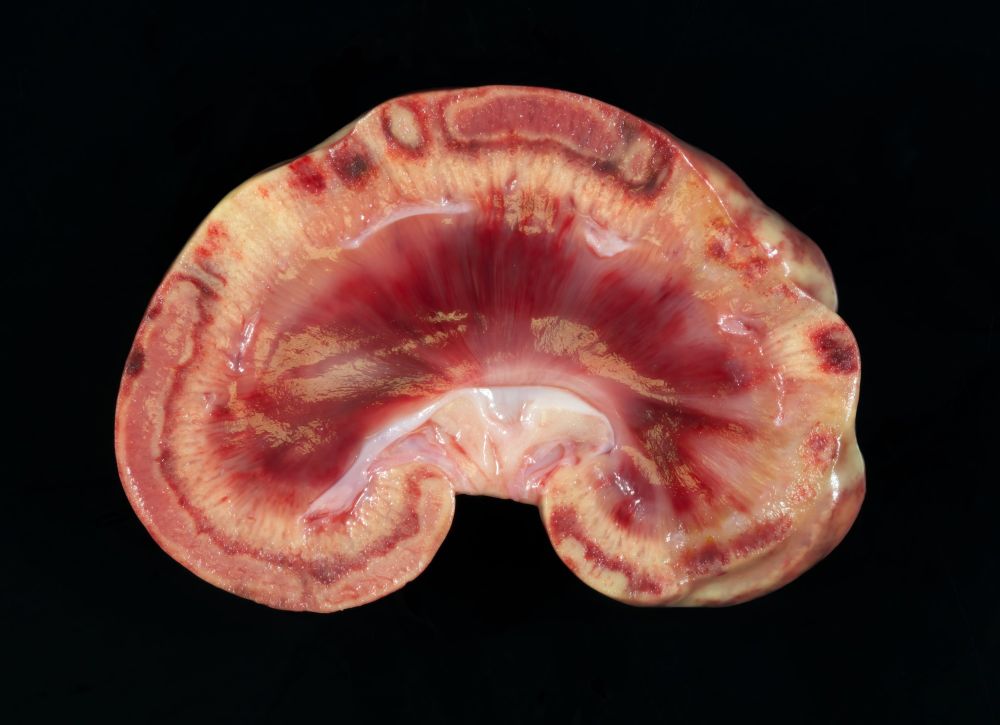 This is the cut surface of a kidney that has been sectioned longitudinally. Six poorly demarcated, dark-red, wedge-shaped foci extend from the corticomedullary margin to the pelvis and are 4 to 7 mm wide at the corticomedullary junction. One, which corresponds to a cranial cortical depression, is itself slightly depressed on cut surface (infarct).The cortex of the left kidney has five, focal to focally extensive discolored foci that are restricted to the superficial one-half of the cortex. The smallest of these are rectangular, dark red foci in which each edge of the rectangular focus is approximately 5 mm. The largest of the superficial cortical foci consists of a 6 cm long band in the outer one-half of the cortex. All of the larger foci have a pink core with a ground glass surface (necrosis) surrounded by a 1-mm-thick yellow margin that is in turn surrounded by a 1-mm-thick, red outer margin of tissue. Close inspection reveals congested glomeruli in the less affected cortex, but these are not visible in the necrotic regions.