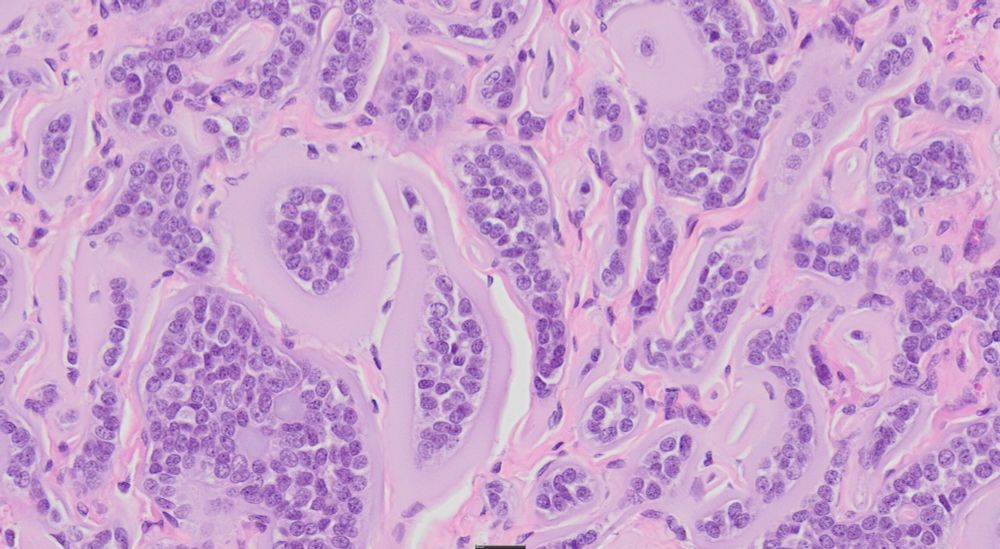 A high magnification view of an ovarian neoplasm from a giant garter snake. The tumor is composed of cords and islands of epithelial cells surrounded by a wide margin of amphophilic material interpreted to be basement membrane material.
