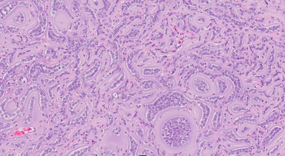 Alternate high magnification view of an ovarian neoplasm from a giant garter snake. The tumor is composed of cords and islands of epithelial cells surrounded by a wide margin of amphophilic material interpreted to be basement membrane material.