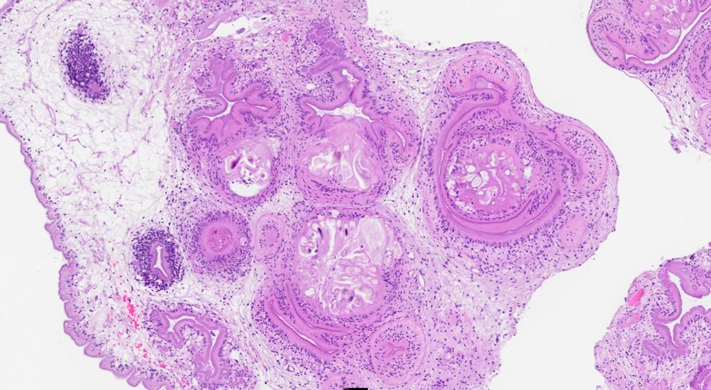 Histopathology slide demonstrating four scolices with hooks and suckers that are variably visible in this section.  The presence of multiple scolices in a cysticercoid tapeworm larvae indicates a coenurus or a hydatid cyst.  This was most likely a coenurus due to a Taenia sp.