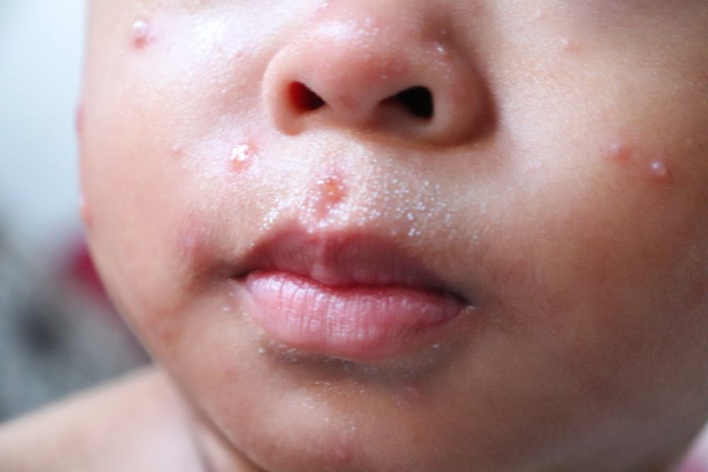 Florida Surgeon General Risks Making a Dangerous Measles Outbreak Much Worse