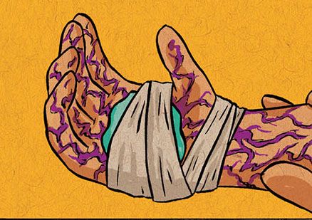 A sample panel from the webcomic At the Inn, focused on a hand, covered in angry purple veins.  The hand has been smeared with teal paste and wrapped in a bandage.