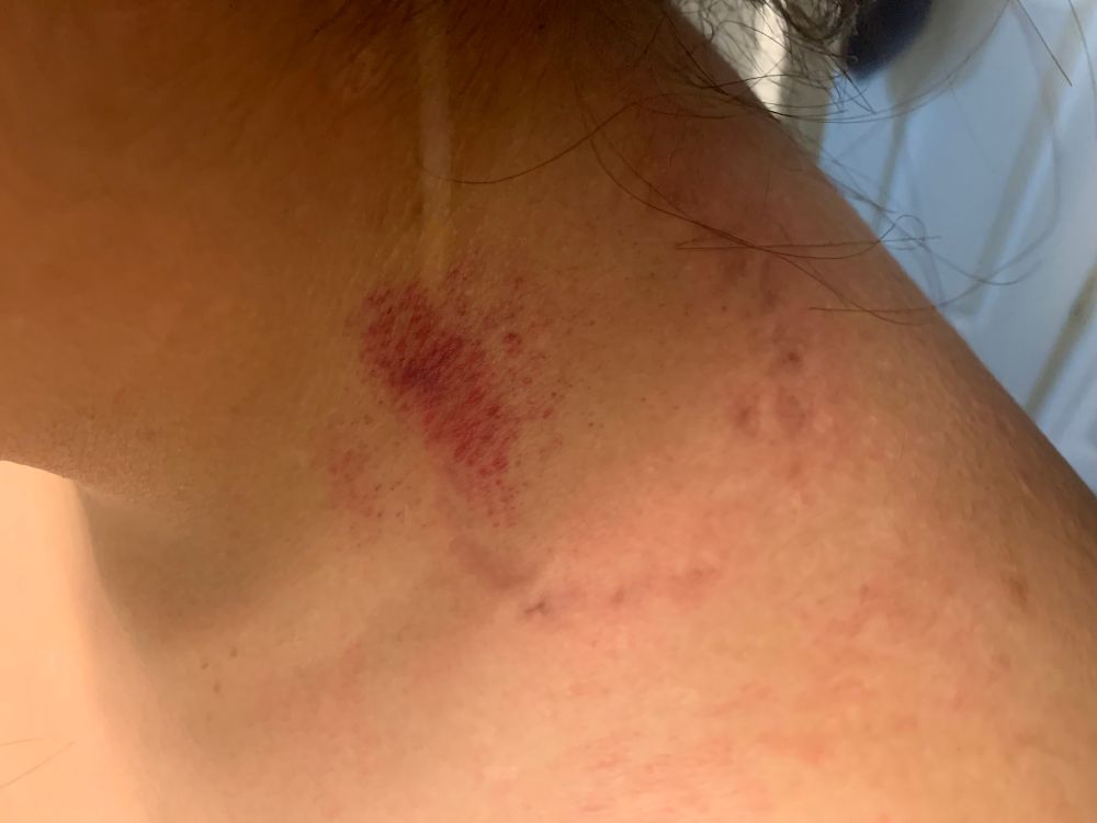 BD with a hickey and a bite mark