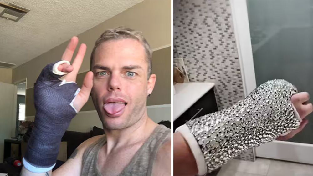 Two photographs. On the left, a young man (McMichaels) sticks out his tongue as he shows off the blue cast on his hand. On the right, he displays the same cast, now fully bedazzled with rhinestones.