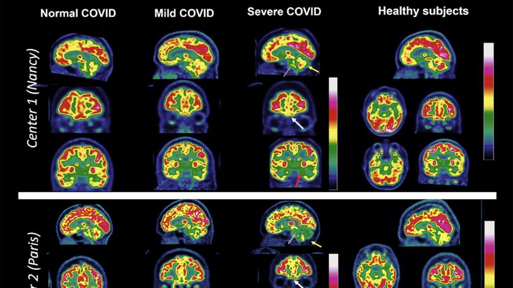 What We Know About Covid’s Impact on Your Brain