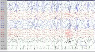 An EEG showing hypsarrythmia 
