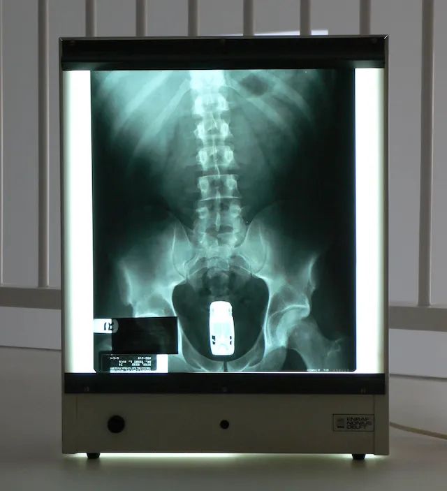 X ray of a toy car in Ryan Dunns butt from jackass 1