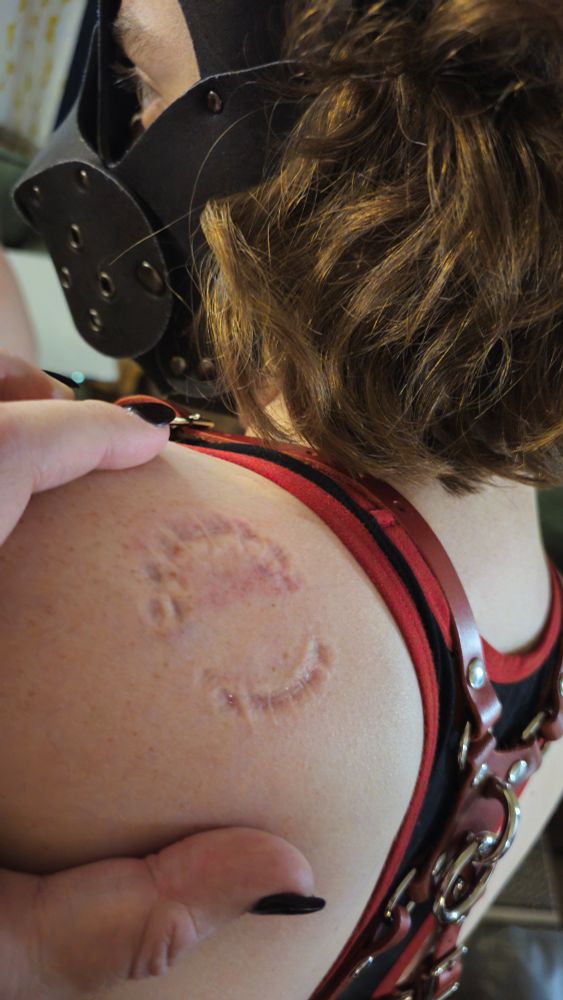 A photo of very deep teeth marks in the shoulder of a pretty girl wearing a red harness.
 