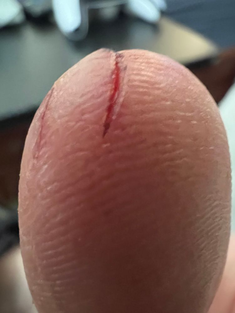 Gross thumb, twice cut by the goddamn mandolin, seriously watch out for those and fear them. It’s so extremely close up that it’s abstracted into a gross veiny orb w a slight gouge and a more moderate gouge next to it. It’s kinda like a gross egg or the alien teaser trailer.