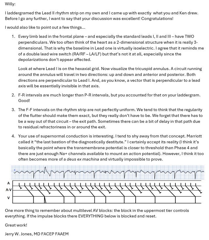 Discussion of multilevel AV block.