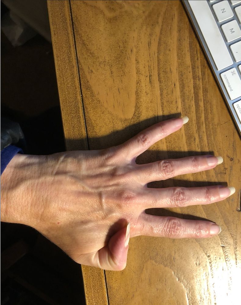 The distal phalanx on my thumb is bent at a 90 degree angle across the back of my hand.