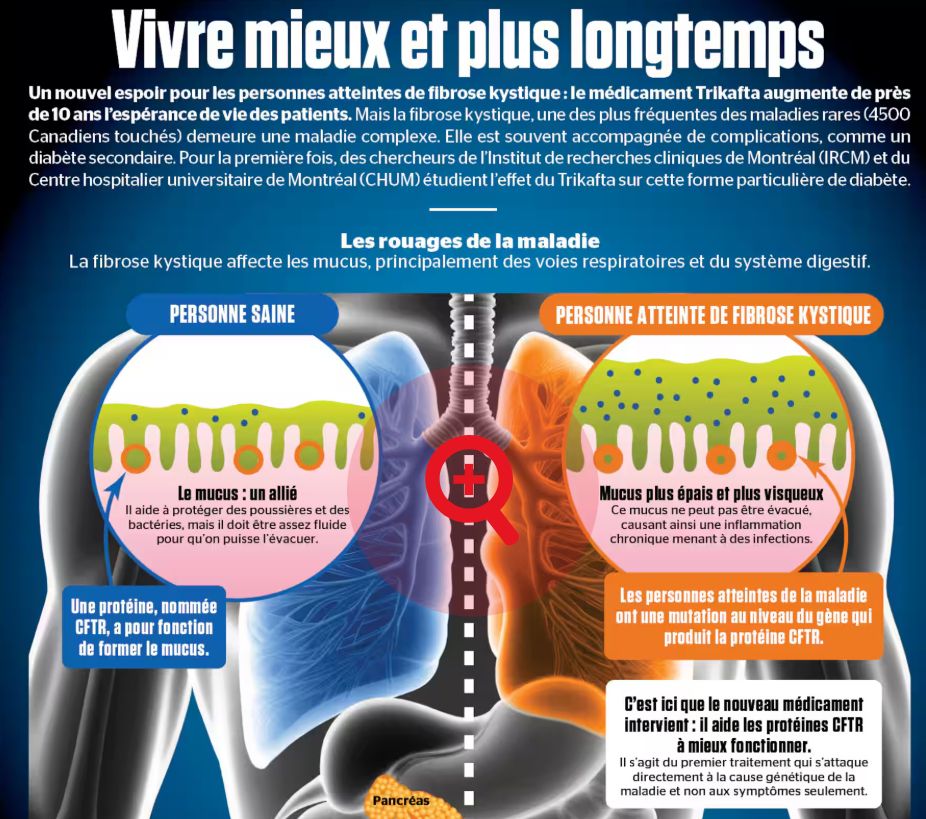 À l’occasion du Mois de sensibilisation à la fibrose kystique, découvrez le très beau dossier visuel réalisé par le Journal de Montréal, en collaboration avec l’IRCM. L’arrivée du médicament Trikafta représente une avancée majeure pour les personnes vivant avec la fibrose kystique, en augmentant leur espérance de vie d’environ dix ans. Toutefois, une incertitude demeure : quel impact ce traitement pourrait-il avoir sur le diabète secondaire, une complication qui touche plus d’un adulte sur deux atteint de cette maladie?
🔎En savoir plus: https://bit.ly/45j9qyM