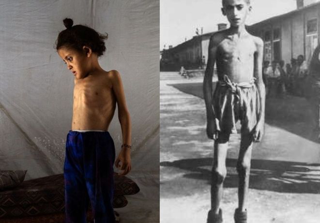 In Gaza, a small child shown in starvation, the body shrunk to nothing with sticks for arms (photo credit New Yorker Magazine), compared to a similar story in a WWII concentration camp, a starving Jewish boy with sticks for arms and legs. All bone, no flesh.