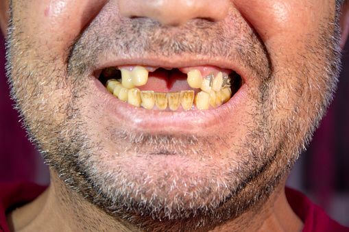 Close-up of toothless man laughing with yellowed teeth